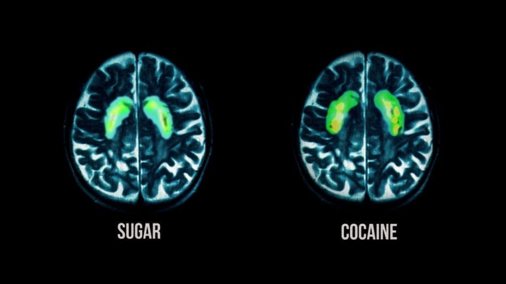 Fed Up Documentary Sugar and Cocaine Brain Scans